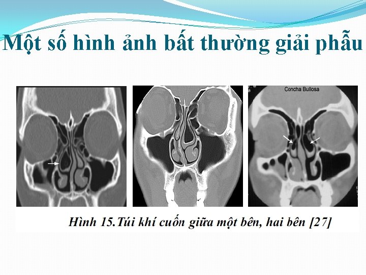 Một số hình ảnh bất thường giải phẫu 