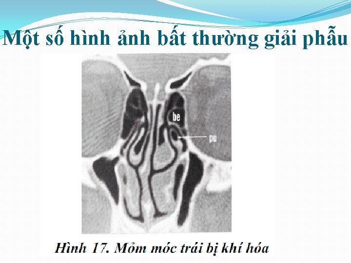 Một số hình ảnh bất thường giải phẫu 