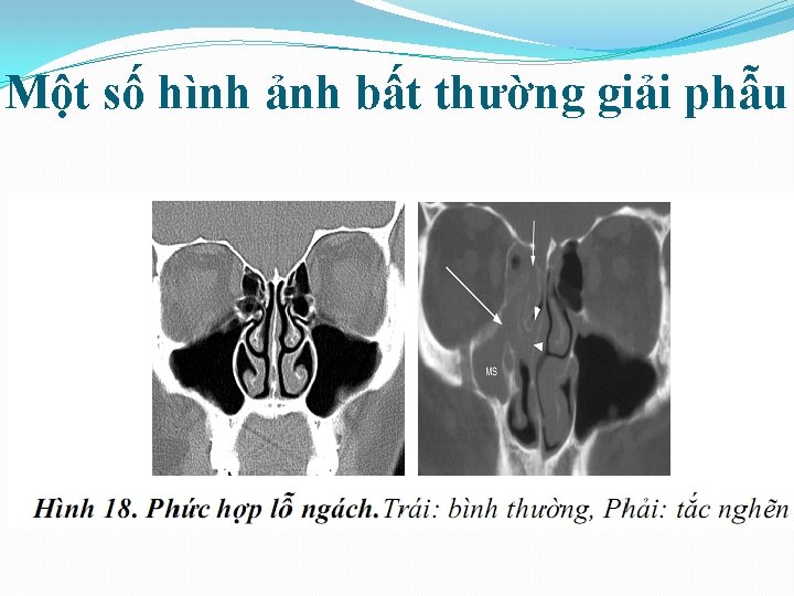 Một số hình ảnh bất thường giải phẫu 