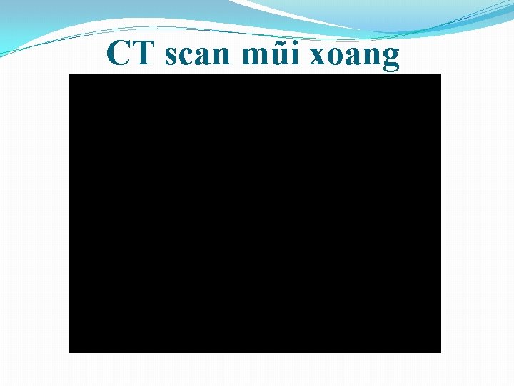 CT scan mũi xoang 