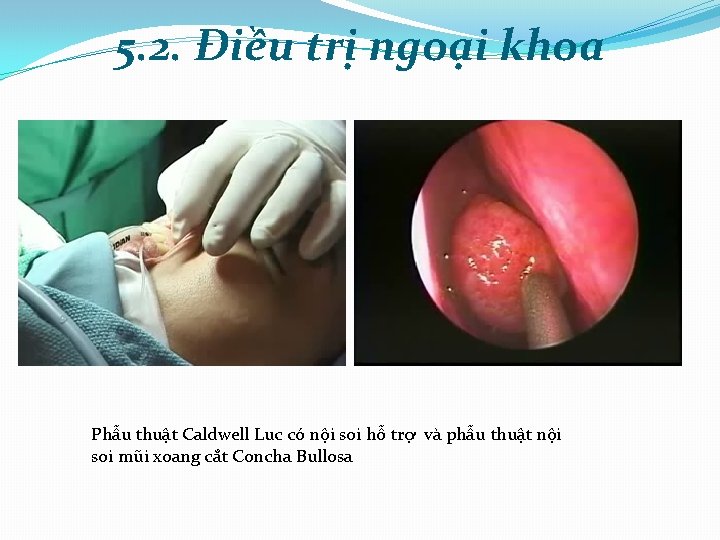 5. 2. Điều trị ngoại khoa Phẫu thuật Caldwell Luc có nội soi hỗ