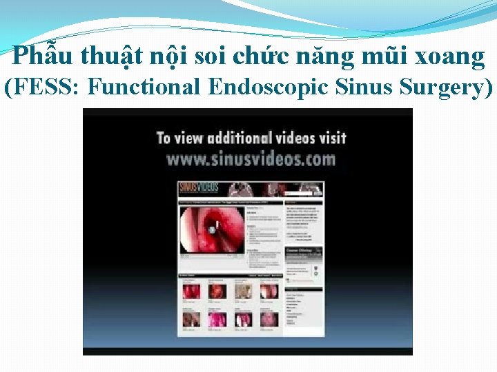 Phẫu thuật nội soi chức năng mũi xoang (FESS: Functional Endoscopic Sinus Surgery) 