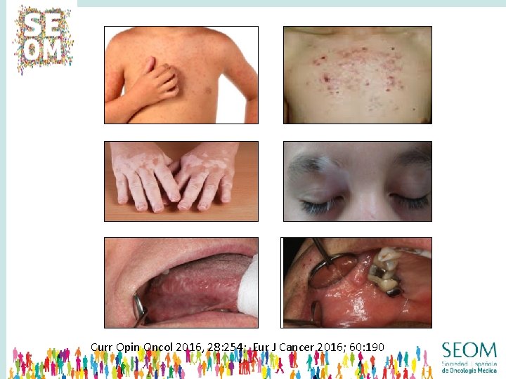 Curr Opin Oncol 2016, 28: 254; Eur J Cancer 2016; 60: 190 