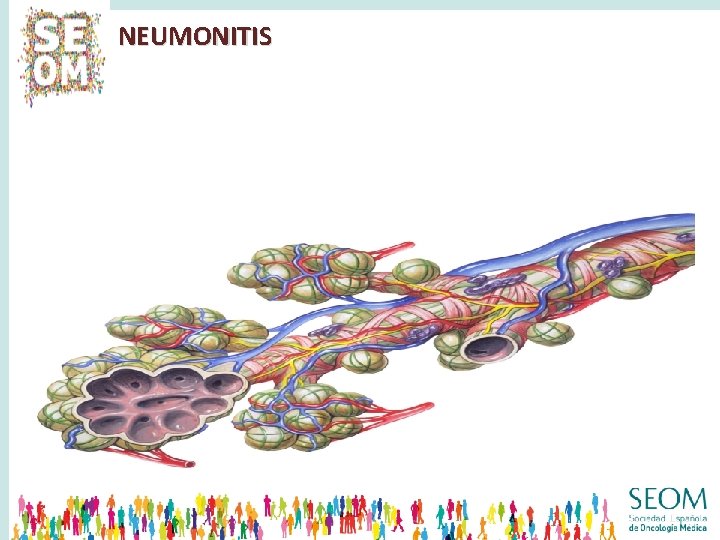 NEUMONITIS 