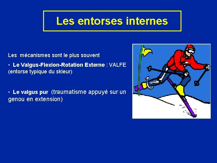 Les entorses internes Les mécanismes sont le plus souvent • Le Valgus-Flexion-Rotation Externe :