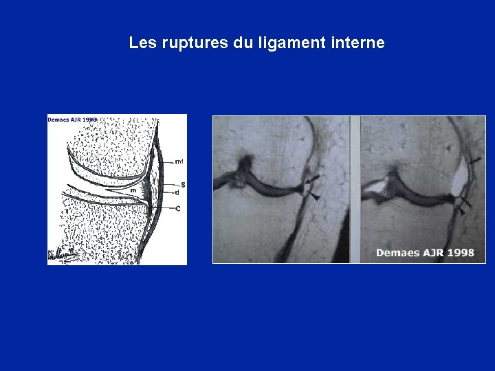 Les ruptures du ligament interne 