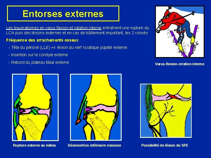 Entorses externes Les traumatismes en varus flexion et rotation interne entraînent une rupture du Entorses externes Les traumatismes en varus flexion et rotation interne entraînent une rupture du