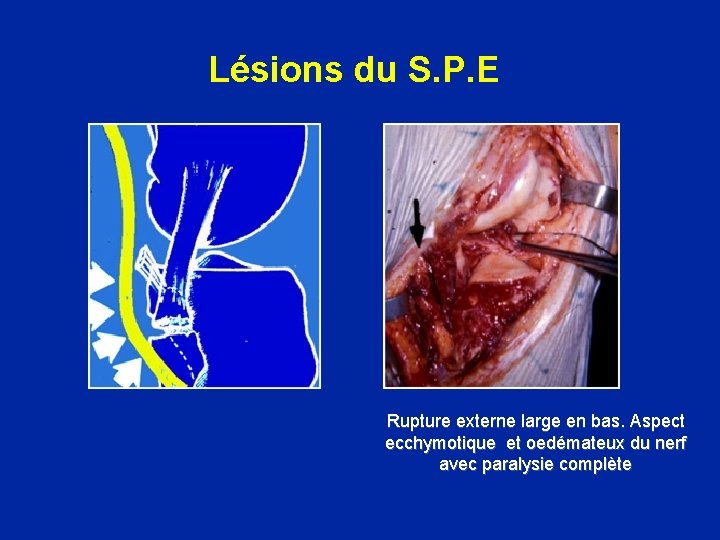 Lésions du S. P. E Rupture externe large en bas. Aspect ecchymotique et oedémateux