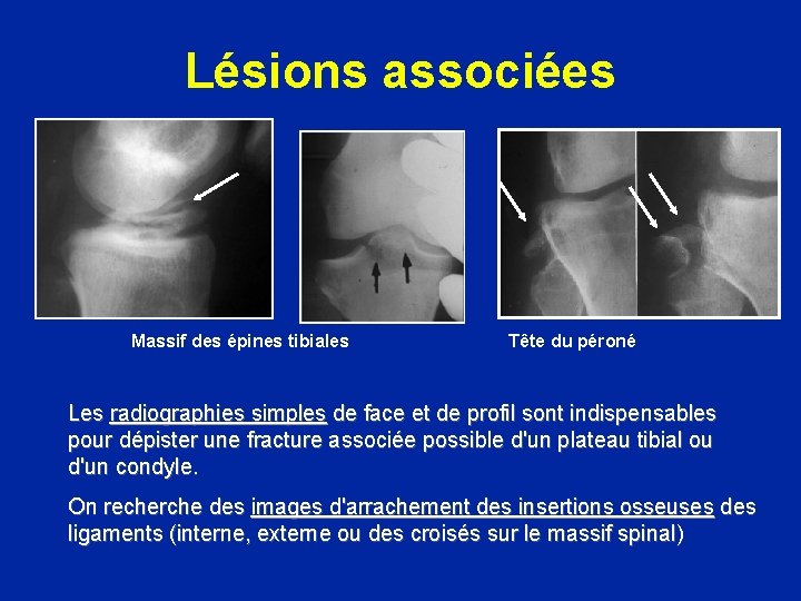 Lésions associées Massif des épines tibiales Tête du péroné Les radiographies simples de face