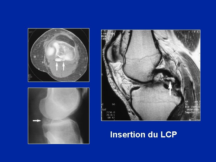 Insertion du LCP 