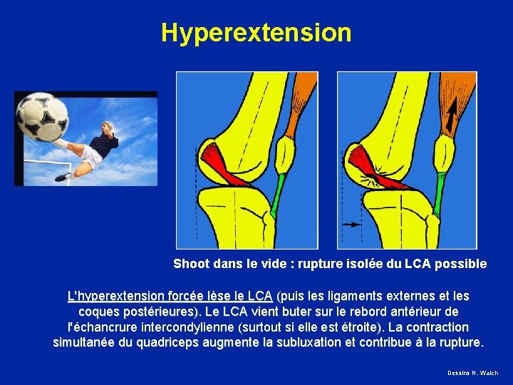 Hyperextension Shoot dans le vide : rupture isolée du LCA possible L'hyperextension forcée lèse