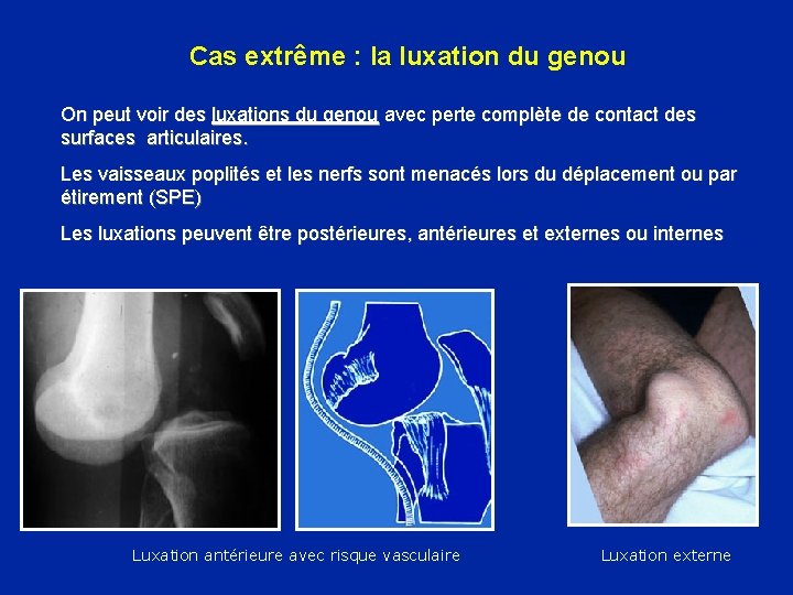 Cas extrême : la luxation du genou On peut voir des luxations du genou Cas extrême : la luxation du genou On peut voir des luxations du genou