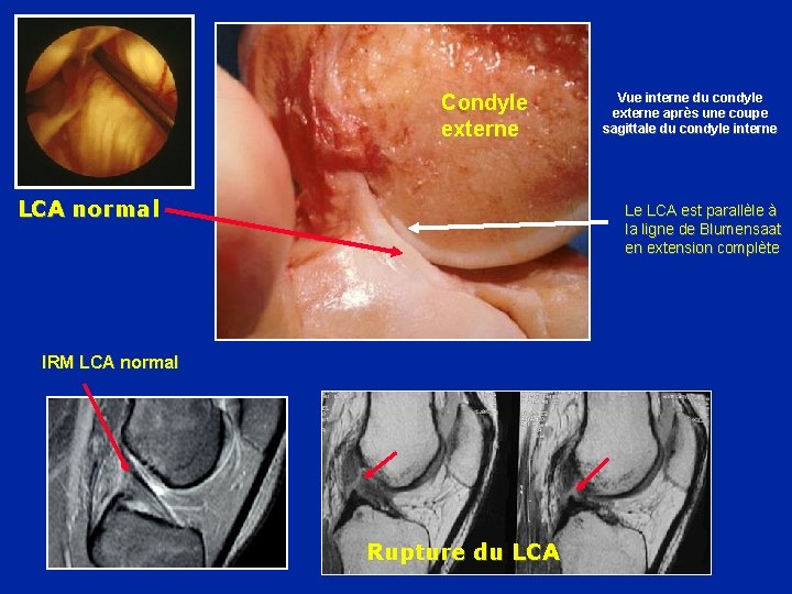 Condyle externe LCA normal Vue interne du condyle externe après une coupe sagittale du