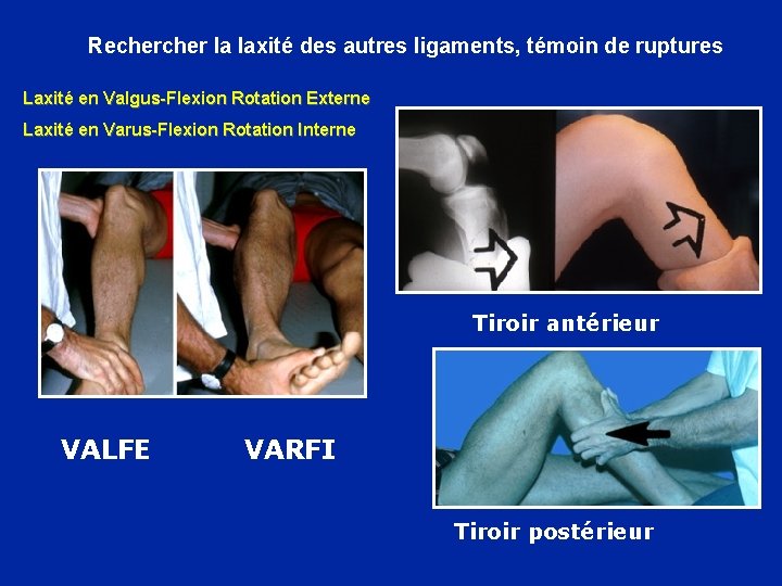 Recher la laxité des autres ligaments, témoin de ruptures Laxité en Valgus-Flexion Rotation Externe