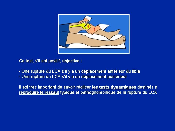 Ce test, s'il est positif, objective : - Une rupture du LCA s’il y