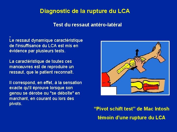 Diagnostic de la rupture du LCA Test du ressaut antéro-latéral Le ressaut dynamique caractéristique