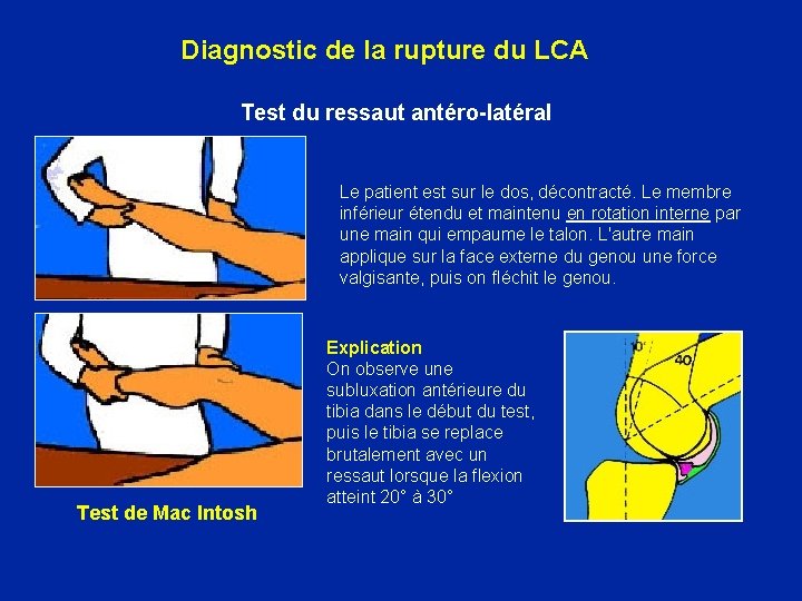 Diagnostic de la rupture du LCA Test du ressaut antéro-latéral Le patient est sur
