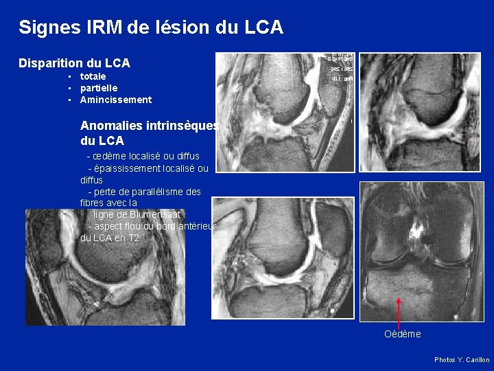 Signes IRM de lésion du LCA Disparition du LCA • totale • partielle •