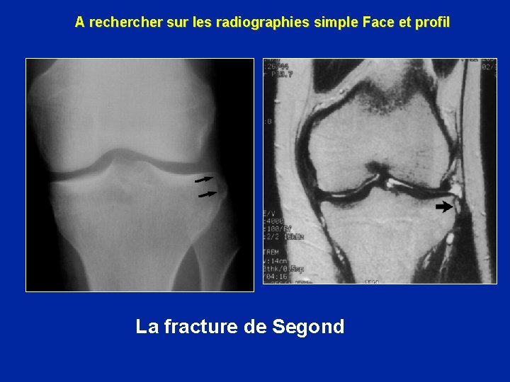 A recher sur les radiographies simple Face et profil La fracture de Segond 