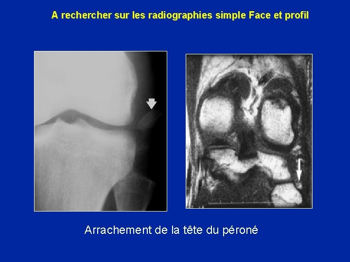 A recher sur les radiographies simple Face et profil Arrachement de la tête du