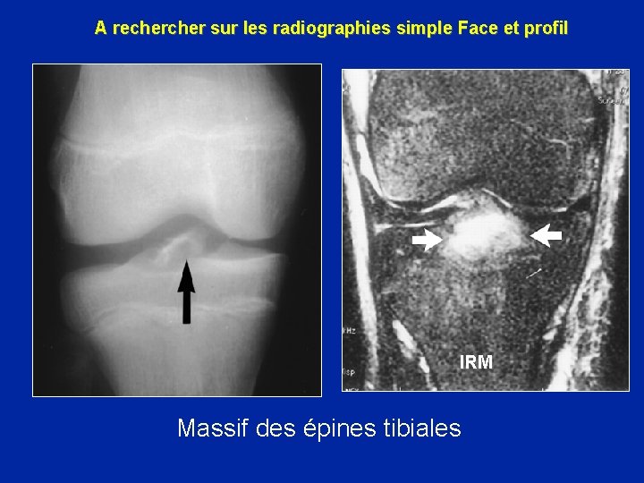 A recher sur les radiographies simple Face et profil IRM Massif des épines tibiales