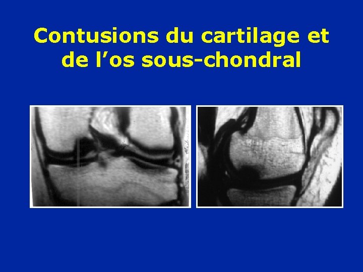 Contusions du cartilage et de l’os sous-chondral 