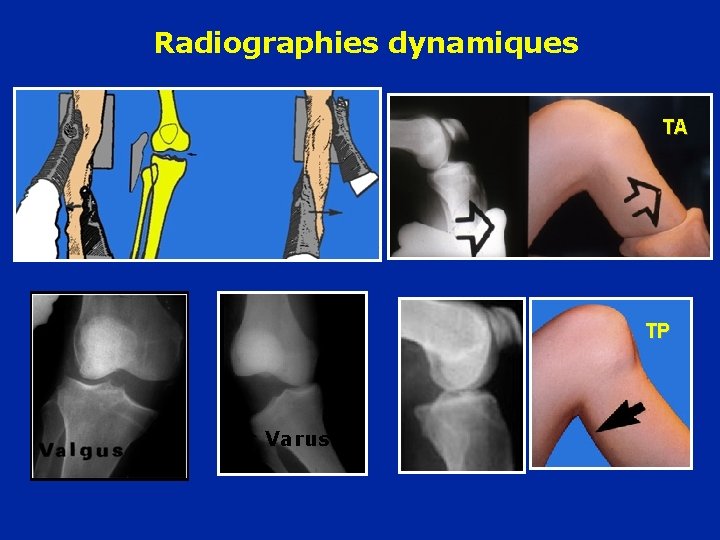 Radiographies dynamiques TA TP Varus Radiographies dynamiques TA TP Varus
