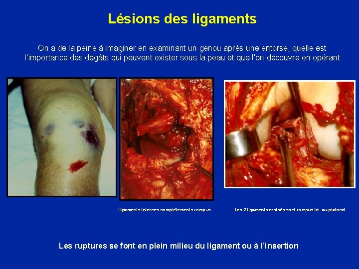 Lésions des ligaments On a de la peine à imaginer en examinant un genou