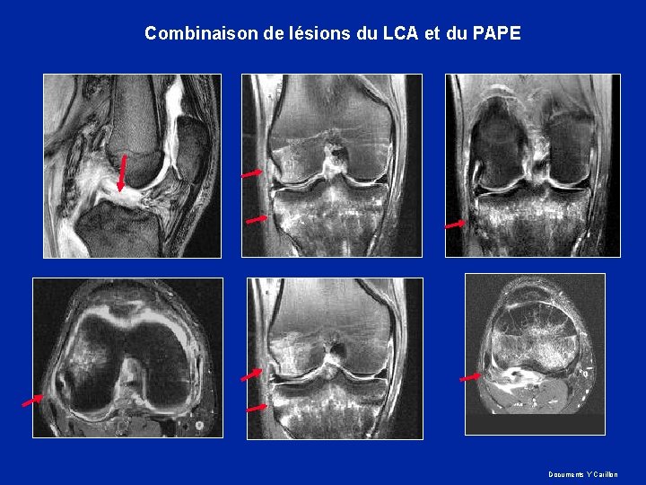 Combinaison de lésions du LCA et du PAPE Documents Y Carillon 