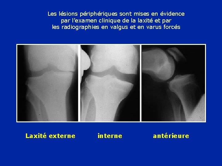 Les lésions périphériques sont mises en évidence par l’examen clinique de la laxité et