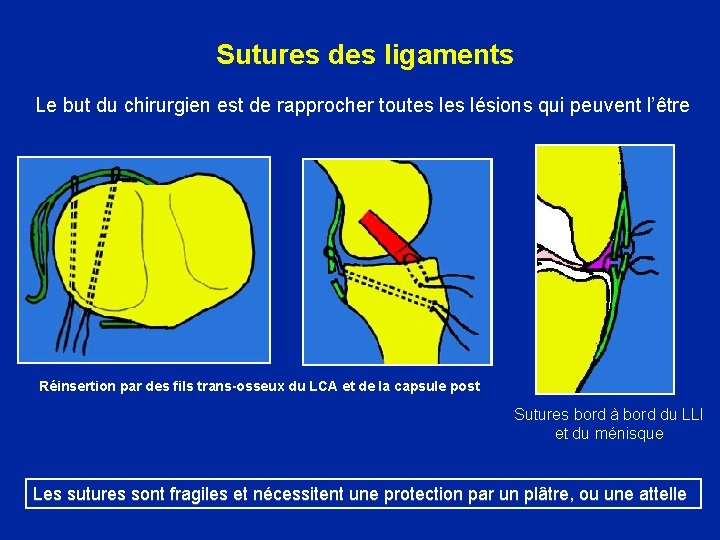 Sutures des ligaments Le but du chirurgien est de rapprocher toutes lésions qui peuvent