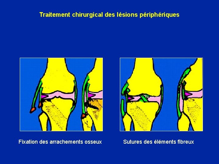 Traitement chirurgical des lésions périphériques Fixation des arrachements osseux Sutures des éléments fibreux 