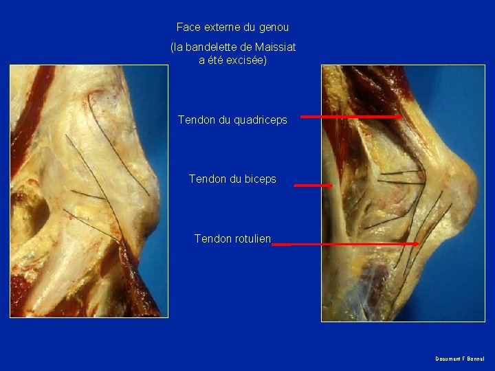 Face externe du genou (la bandelette de Maissiat a été excisée) Tendon du quadriceps