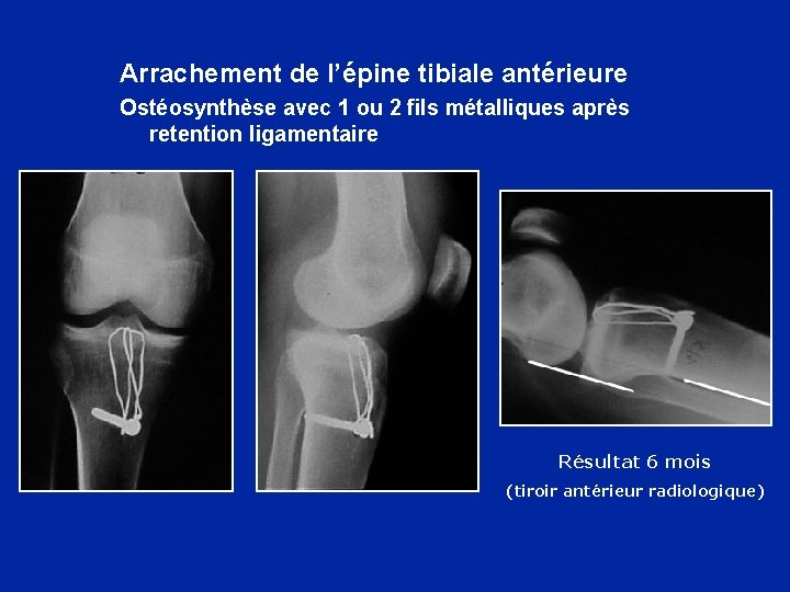 Arrachement de l’épine tibiale antérieure Ostéosynthèse avec 1 ou 2 fils métalliques après retention