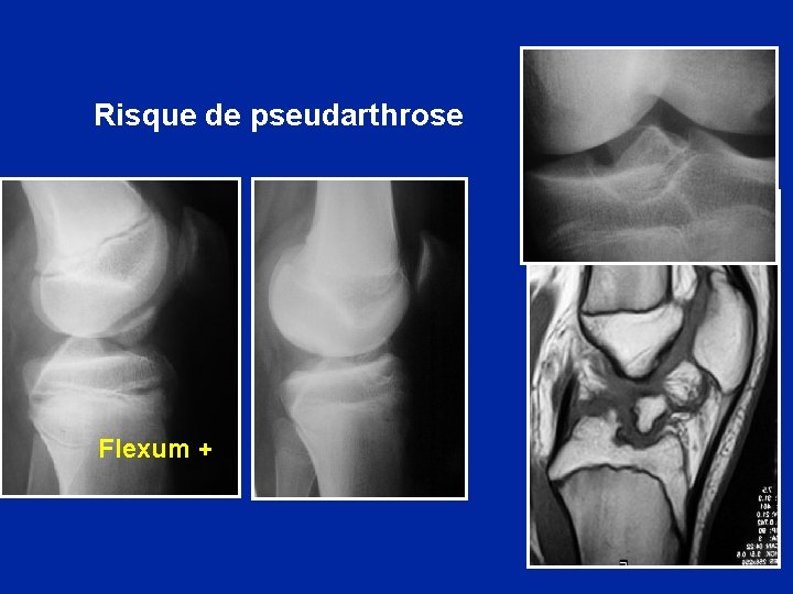 Risque de pseudarthrose Flexum + 