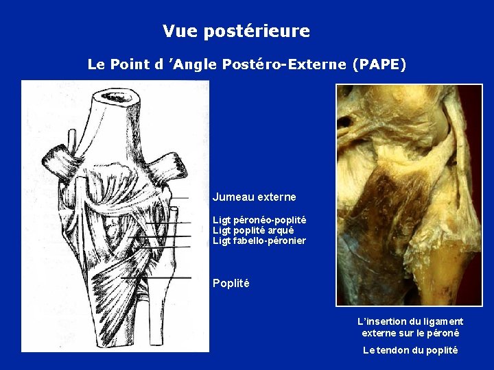 Vue postérieure Le Point d ’Angle Postéro-Externe (PAPE) Jumeau externe Ligt péronéo-poplité Ligt poplité