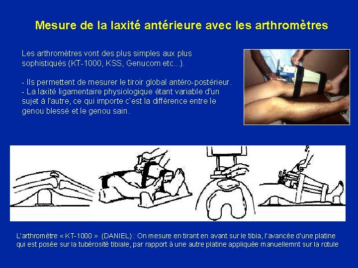 Mesure de la laxité antérieure avec les arthromètres Les arthromètres vont des plus simples