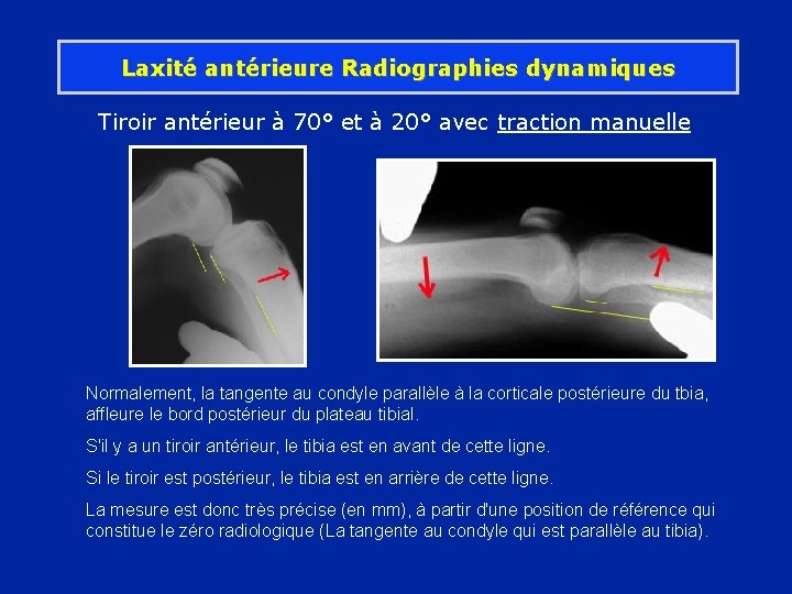 Laxité antérieure Radiographies dynamiques Tiroir antérieur à 70° et à 20° avec traction manuelle