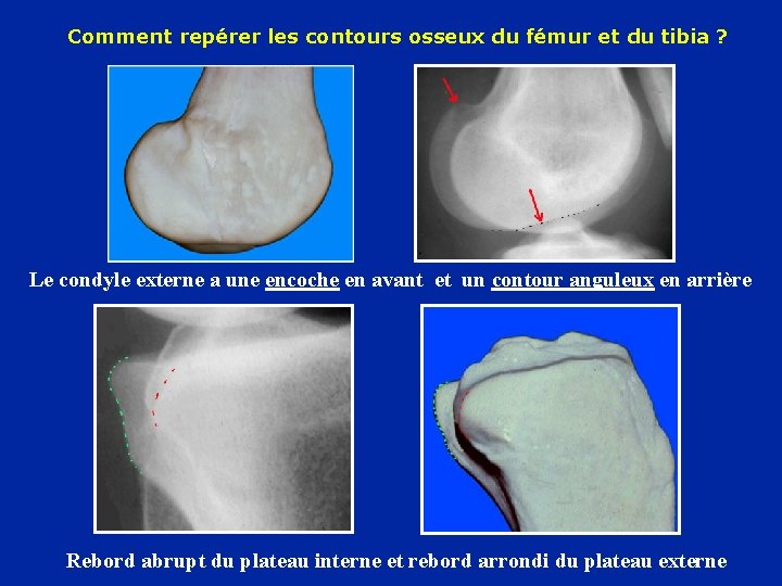 Comment repérer les contours osseux du fémur et du tibia ? Le condyle externe Comment repérer les contours osseux du fémur et du tibia ? Le condyle externe
