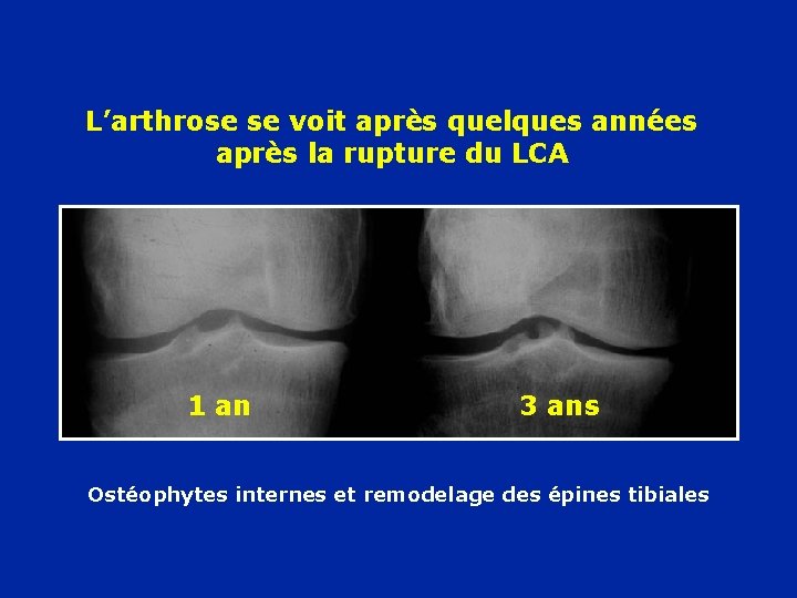 L’arthrose se voit après quelques années après la rupture du LCA 1 an 3