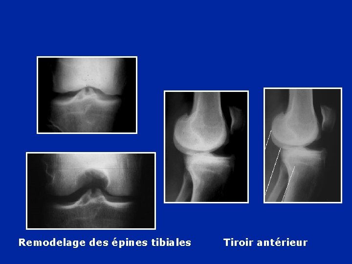 Remodelage des épines tibiales Tiroir antérieur 