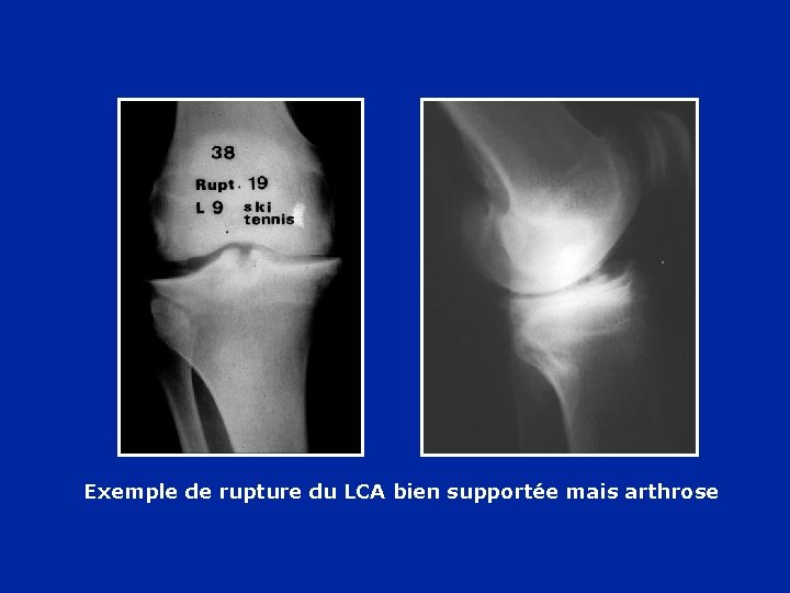 Exemple de rupture du LCA bien supportée mais arthrose Exemple de rupture du LCA bien supportée mais arthrose