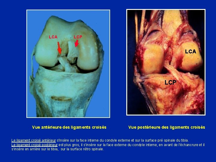 LCA LCP LCA LCP Vue antérieure des ligaments croisés Vue postérieure des ligaments croisés