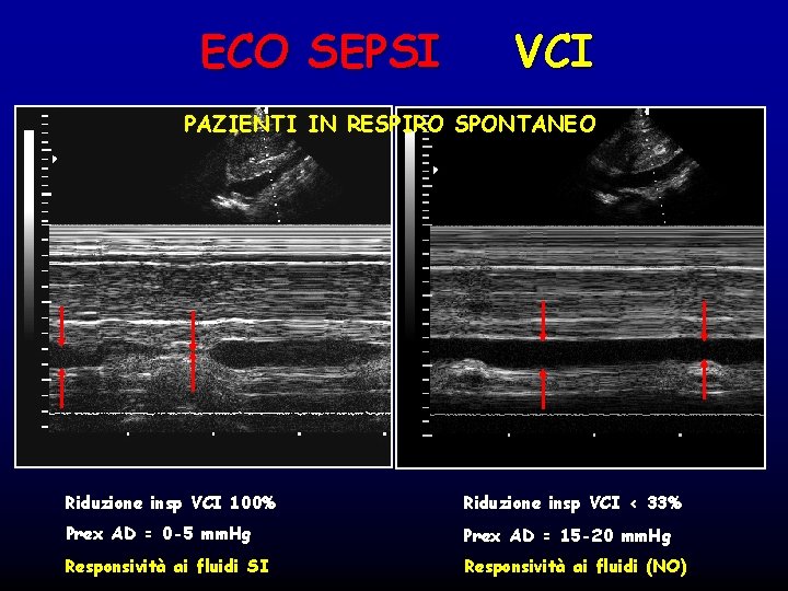 ECO SEPSI VCI PAZIENTI IN RESPIRO SPONTANEO Riduzione insp VCI 100% Riduzione insp VCI