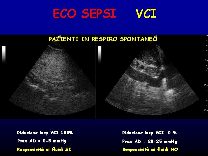 ECO SEPSI VCI PAZIENTI IN RESPIRO SPONTANEO Riduzione insp VCI 100% Riduzione insp VCI