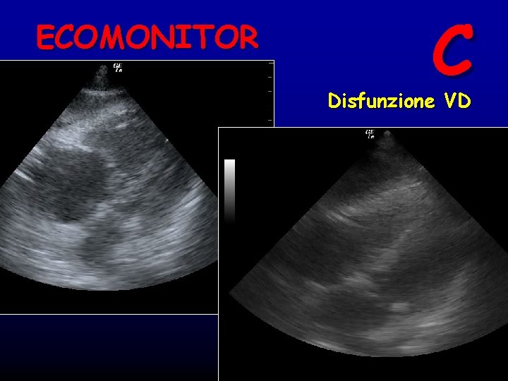 ECOMONITOR C Disfunzione VD 