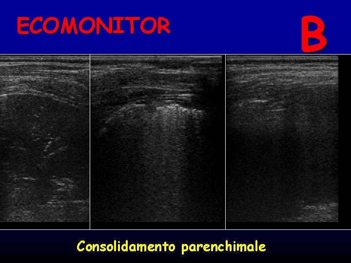 ECOMONITOR Consolidamento parenchimale B 