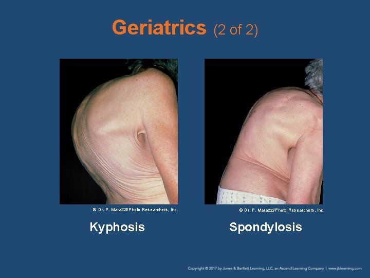 Geriatrics (2 of 2) © Dr. P. Marazzi/Photo Researchers, Inc. Kyphosis © Dr. P.