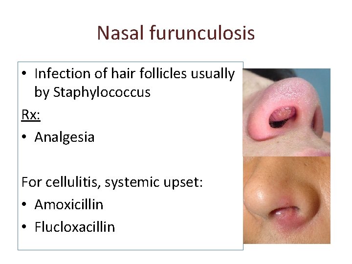 Nasal furunculosis • Infection of hair follicles usually by Staphylococcus Rx: • Analgesia For Nasal furunculosis • Infection of hair follicles usually by Staphylococcus Rx: • Analgesia For
