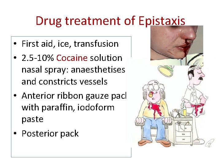 Drug treatment of Epistaxis • First aid, ice, transfusion • 2. 5 -10% Cocaine Drug treatment of Epistaxis • First aid, ice, transfusion • 2. 5 -10% Cocaine